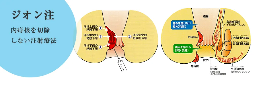 あきやま胃腸科肛門科クリニック さいたま市大宮区 内視鏡検査 痔の治療など